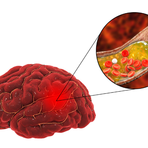 Neurochirurgo per malattie cerebrovascolari a Bologna